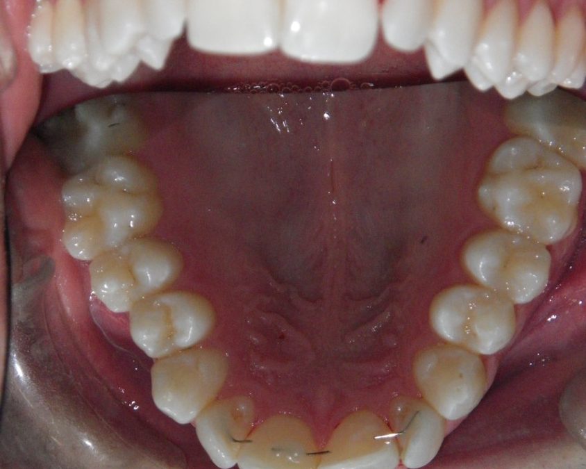 Che cosa sapere sull’ortodonzia e sugli allineatori dentali
