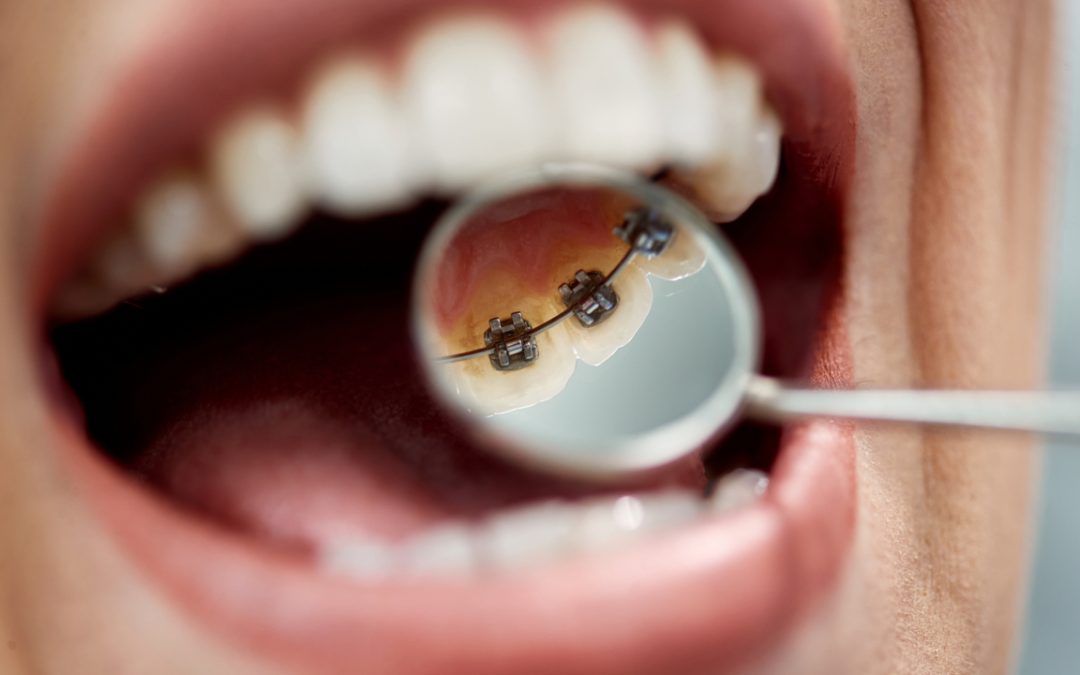 Ortodonzia linguale: raddrizzare i denti con l’apparecchio fisso interno