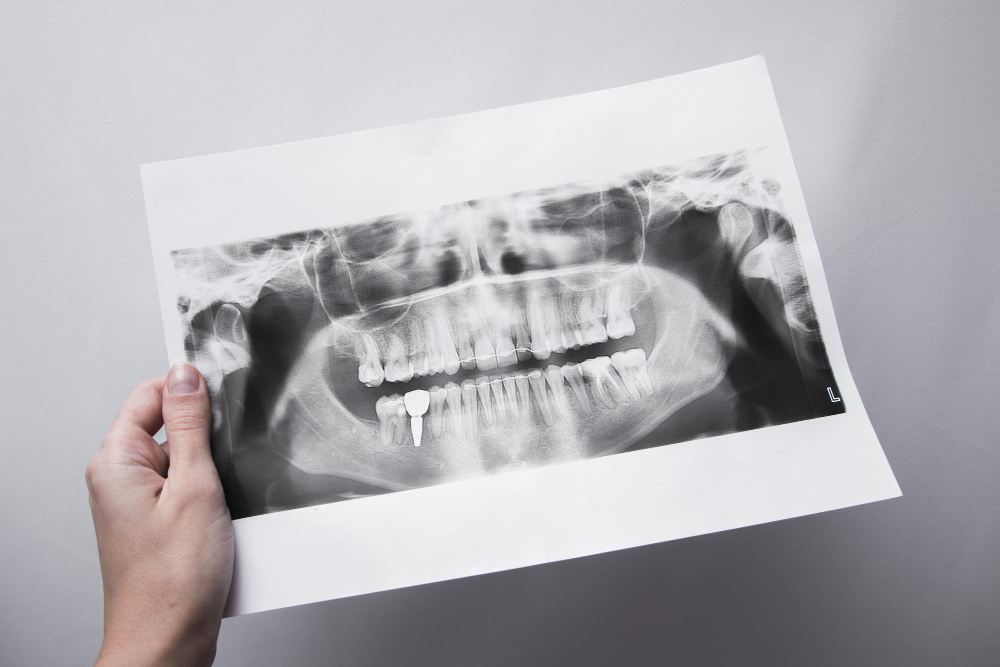 RX Endorali e RX ATM: la radiologia odontoiatrica di ultima generazione